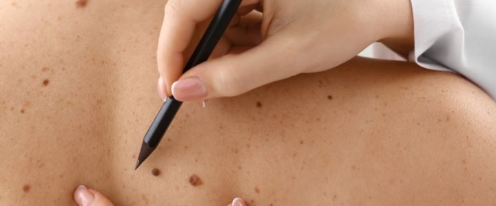 S’informer sur le mélanome !