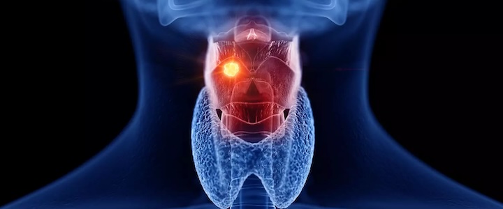 HNO-Krebs: Symptome und Risikofaktoren